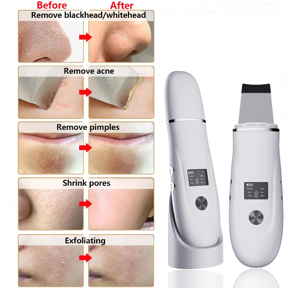 VitaClean Ultrasonic Scrubber – Deep Cleansing & Pore Refining Facial Spatula