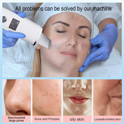 VitaClean Ultrasonic Scrubber – Deep Cleansing & Pore Refining Facial Spatula